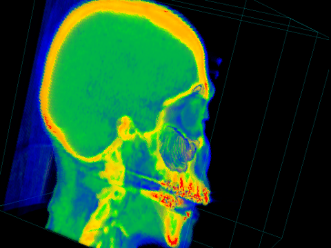 Another view of the Stanford CT Head dataset showing the inside of the head.  Here the transfer function really brings out the differences between the different densities in the dataset, with the skin being blue, the muscles and brain being green, and the bones being either yellow, orange, or red.